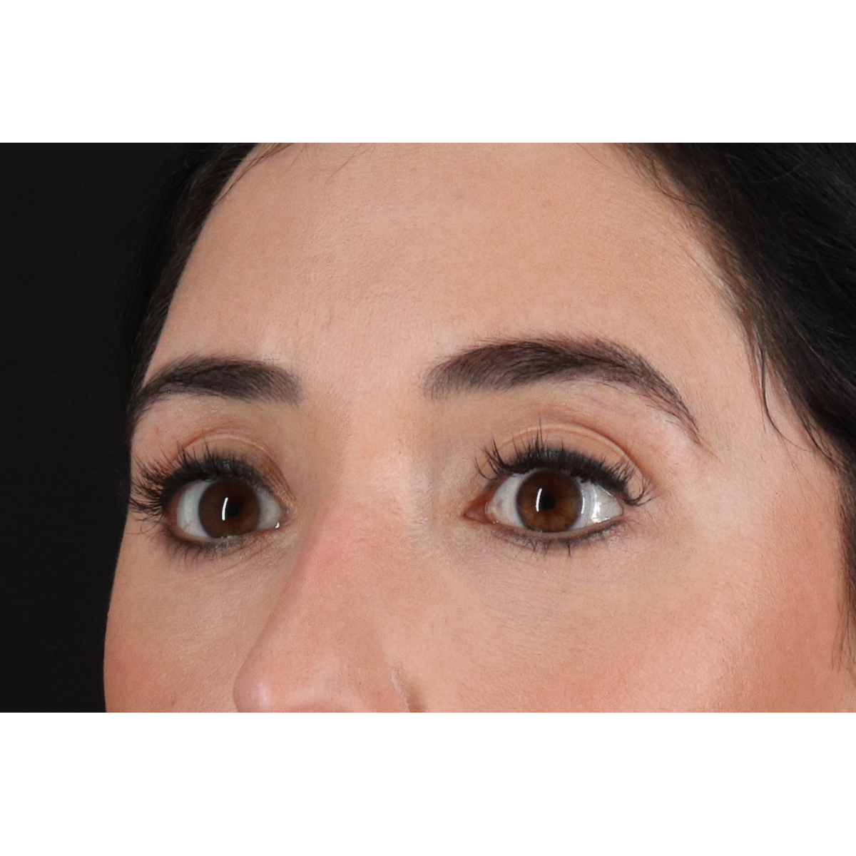 Blepharoplasty (Eyelid Surgery) Before & After Patient #11668