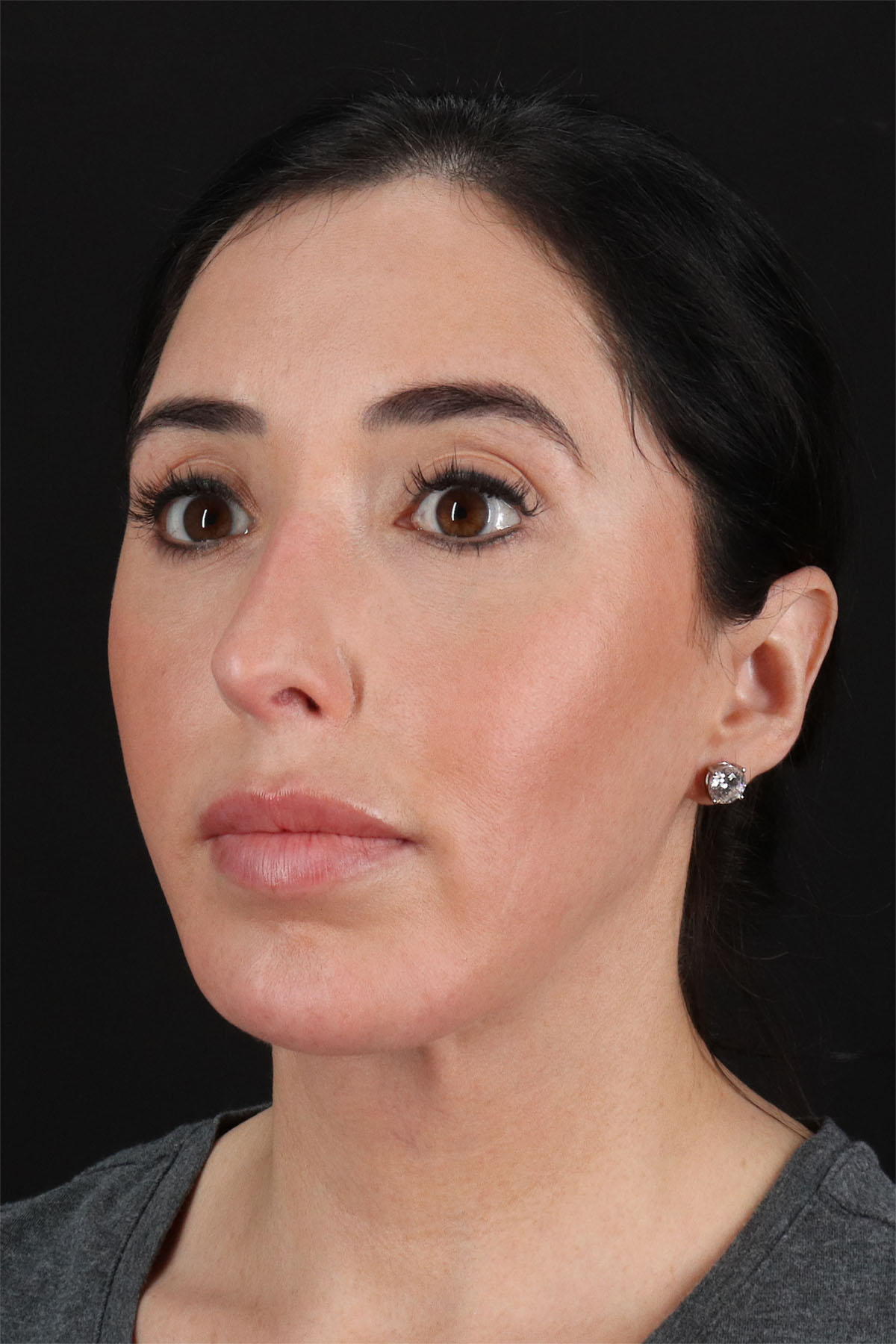 Fat Grafting To The Face Before & After Patient #11783