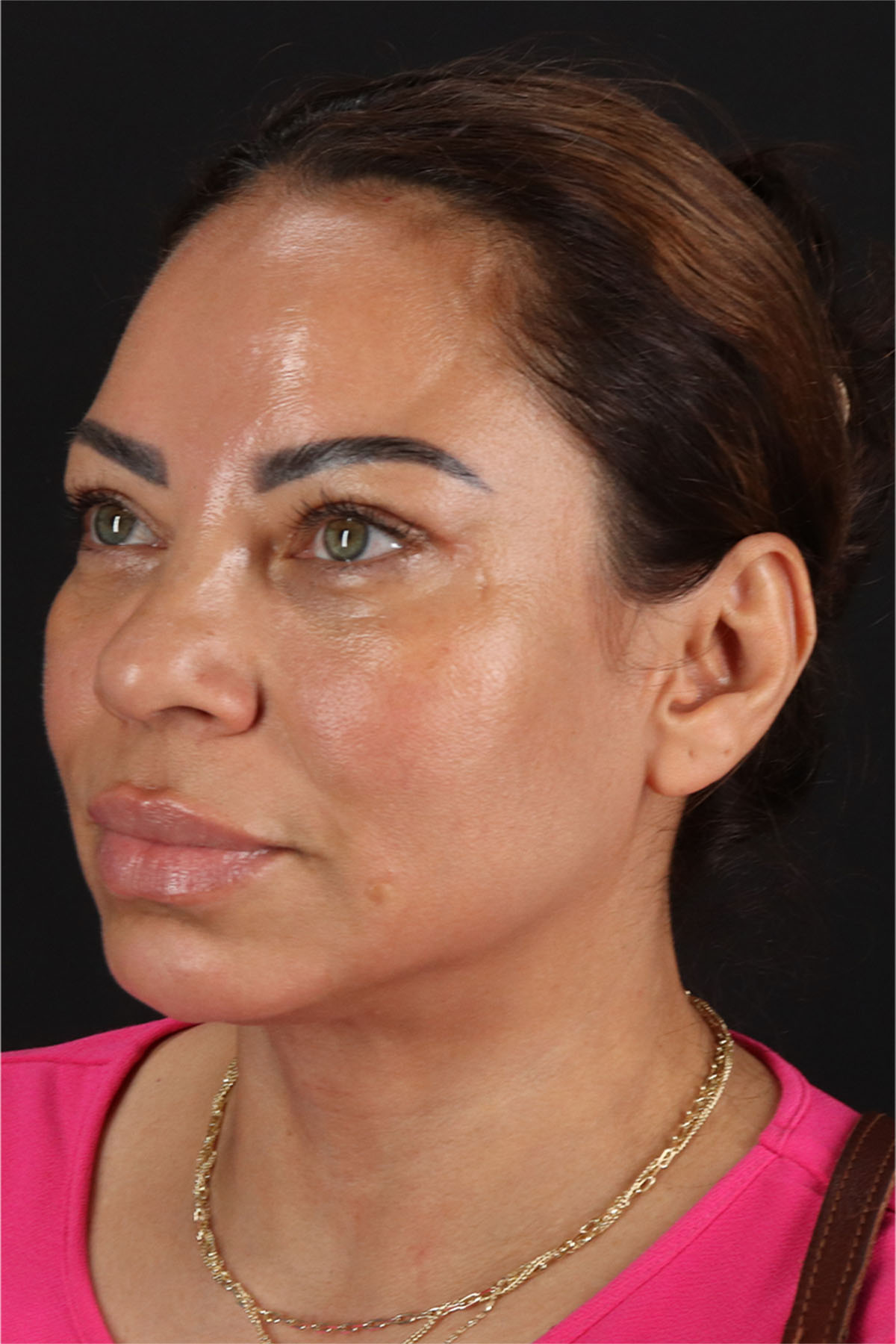 CO2 Laser Before & After Patient #11719