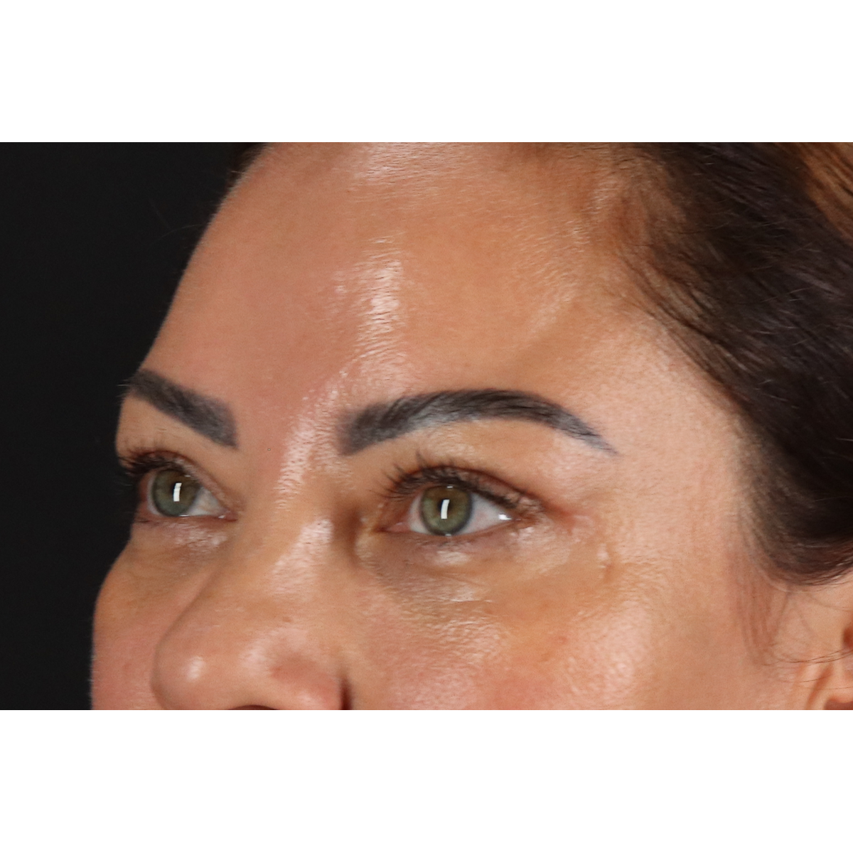 Blepharoplasty (Eyelid Surgery) Before & After Patient #11348