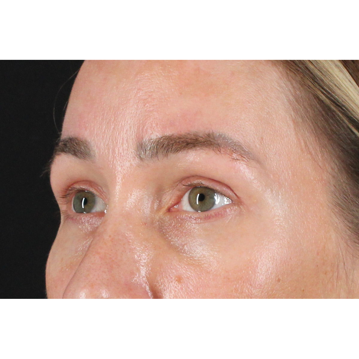 Blepharoplasty (Eyelid Surgery) Before & After Patient #11585