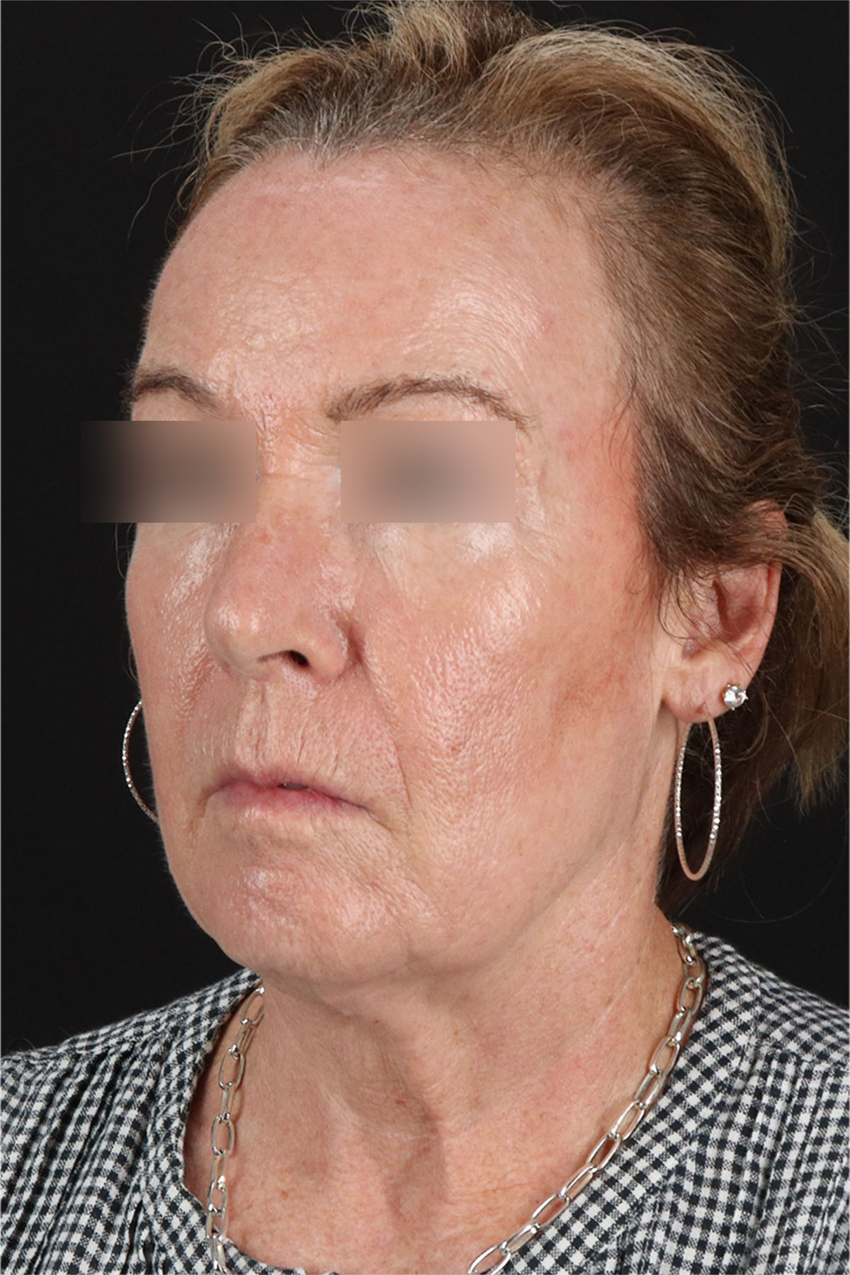CO2 Laser Before & After Patient #11385