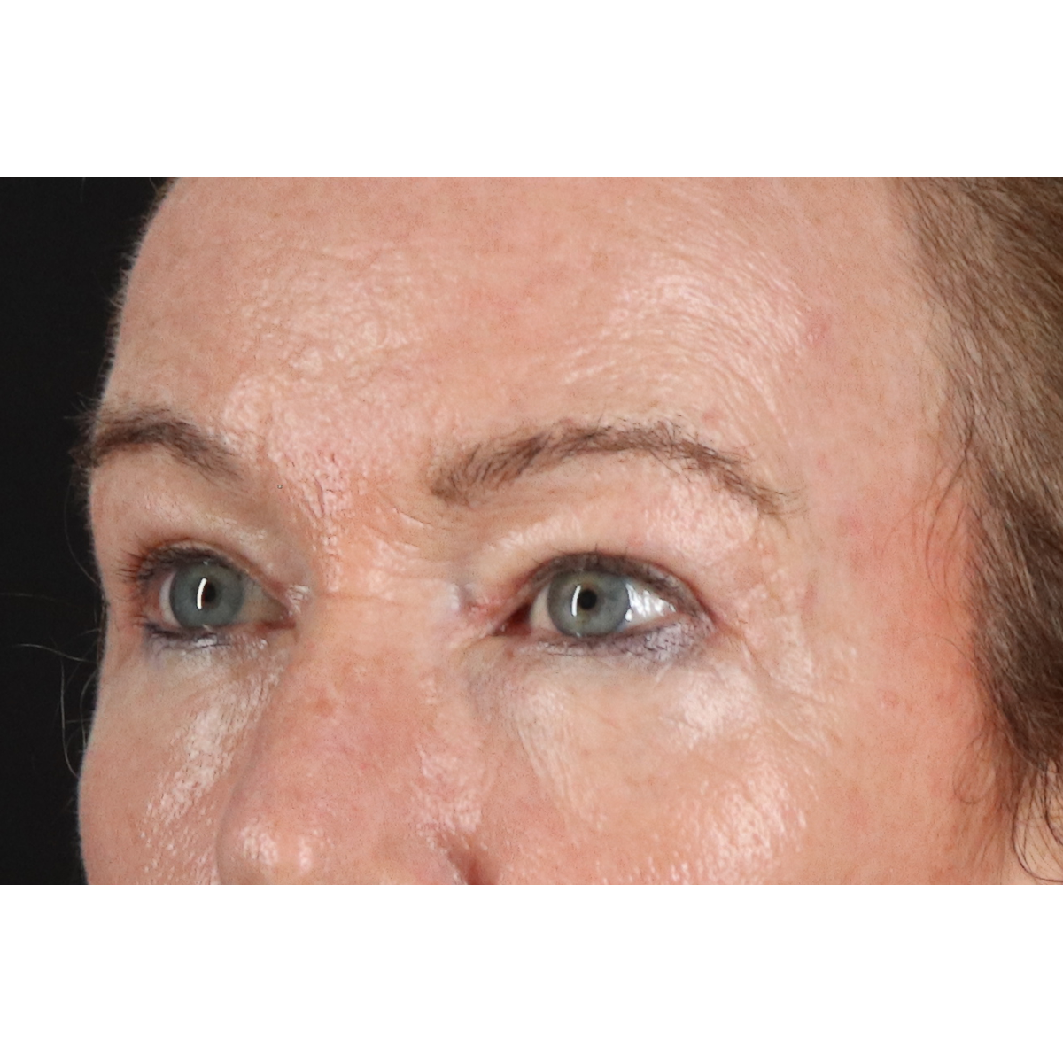 Blepharoplasty (Eyelid Surgery) Before & After Patient #11404