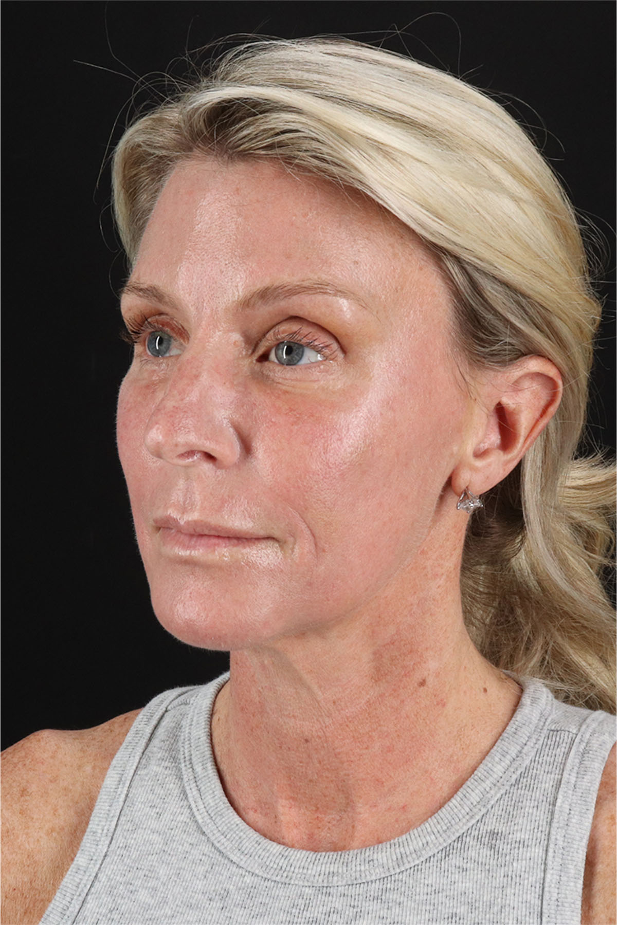 Facelift Before & After Patient #11682