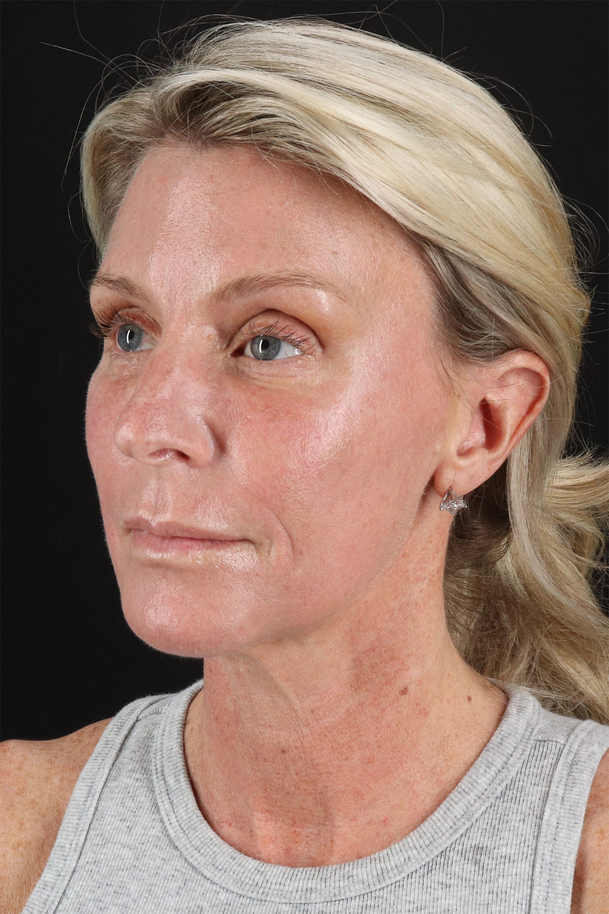 CO2 Laser Before & After Patient #11202