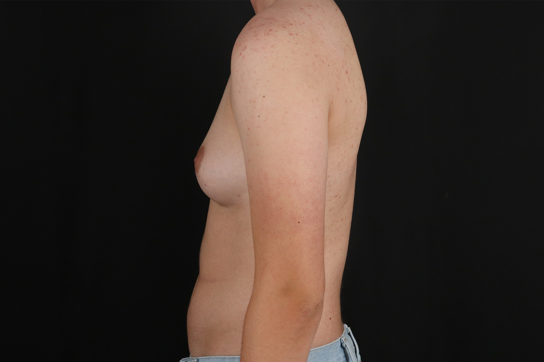 Female To Male Breast Before & After Patient #9981