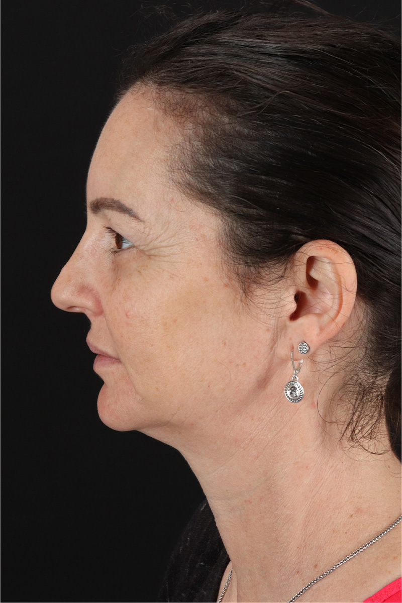 Chemical Peels Before & After Patient #11418