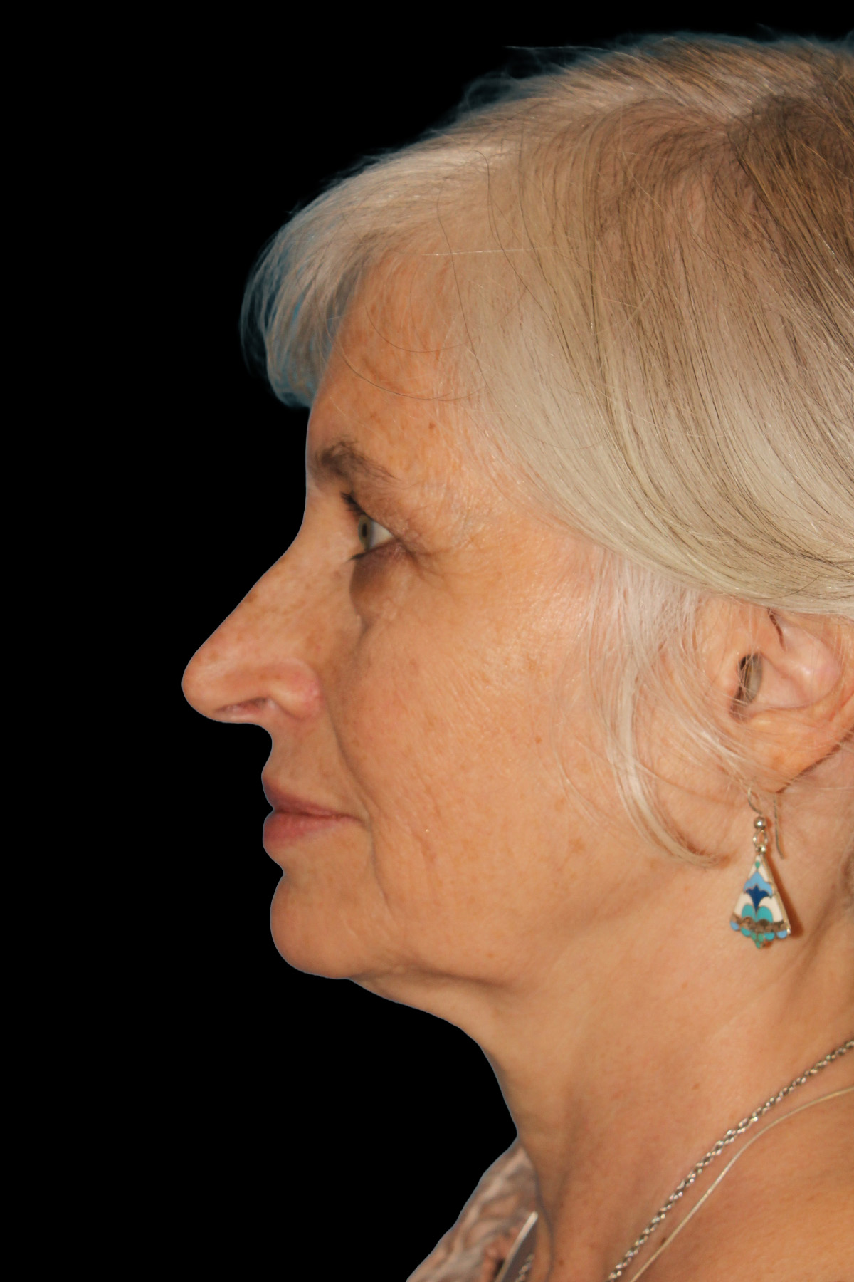 Upper Blepharoplasty Before & After Patient #11996