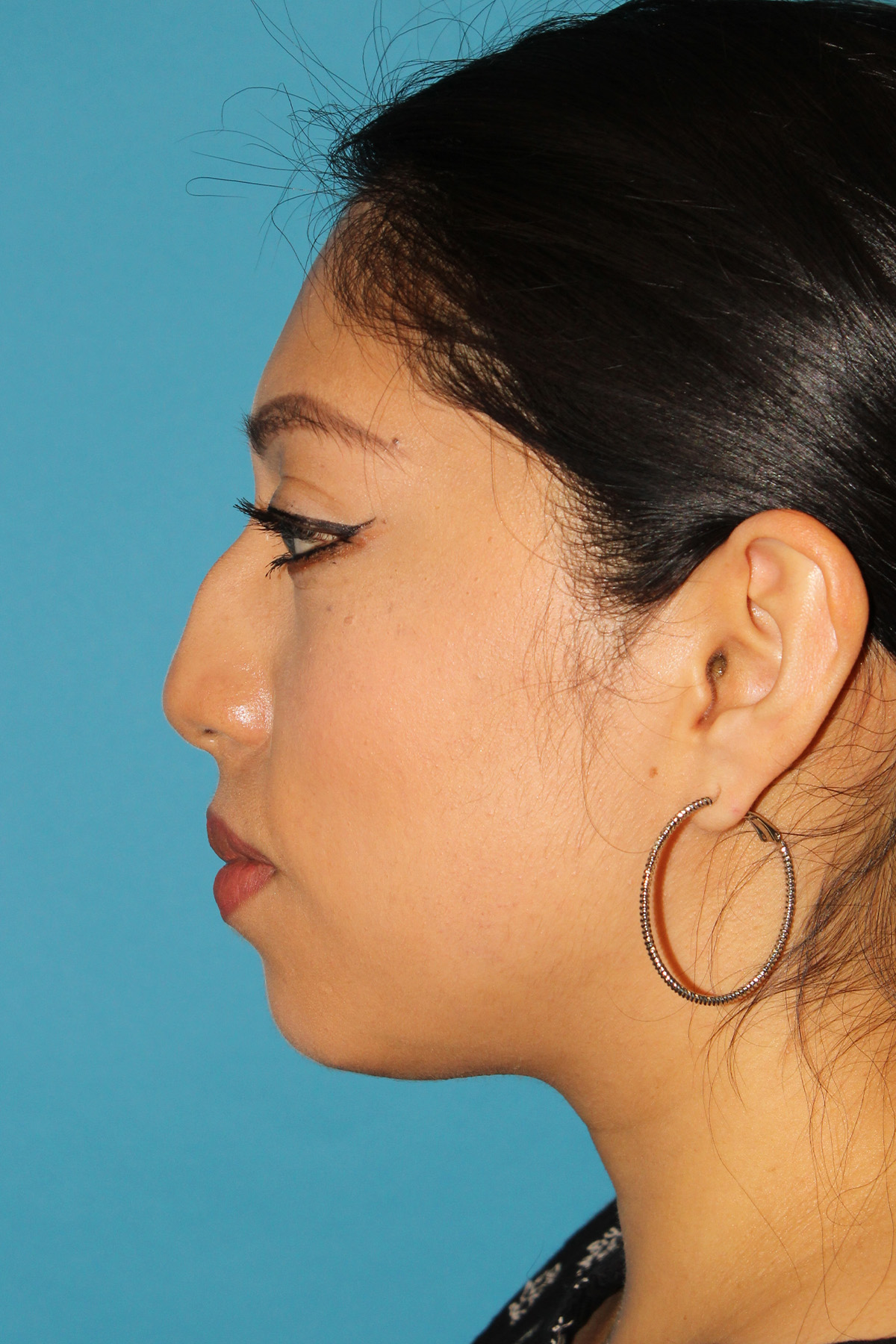 Chin Implant Before & After Patient #13673