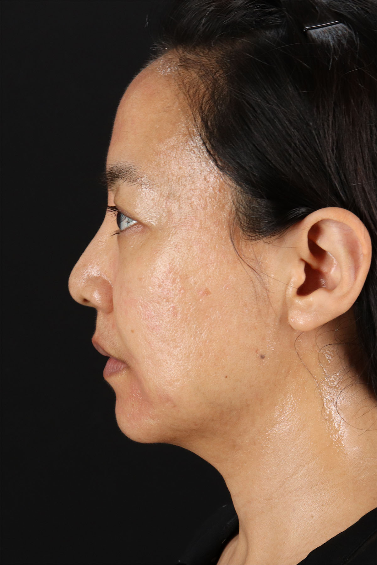 CO2 Laser Before & After Patient #11059