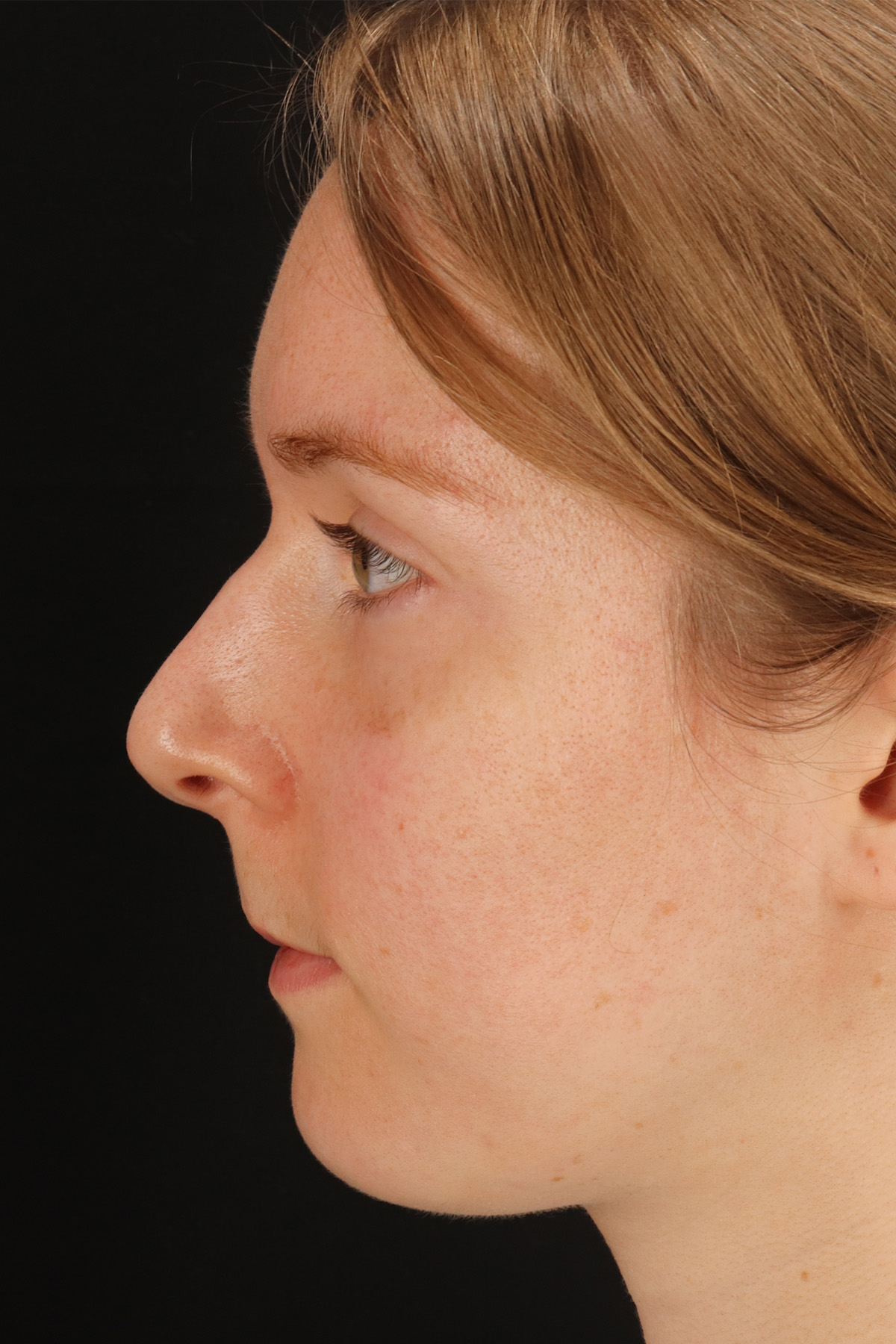 Rhinoplasty Before & After Patient #12238