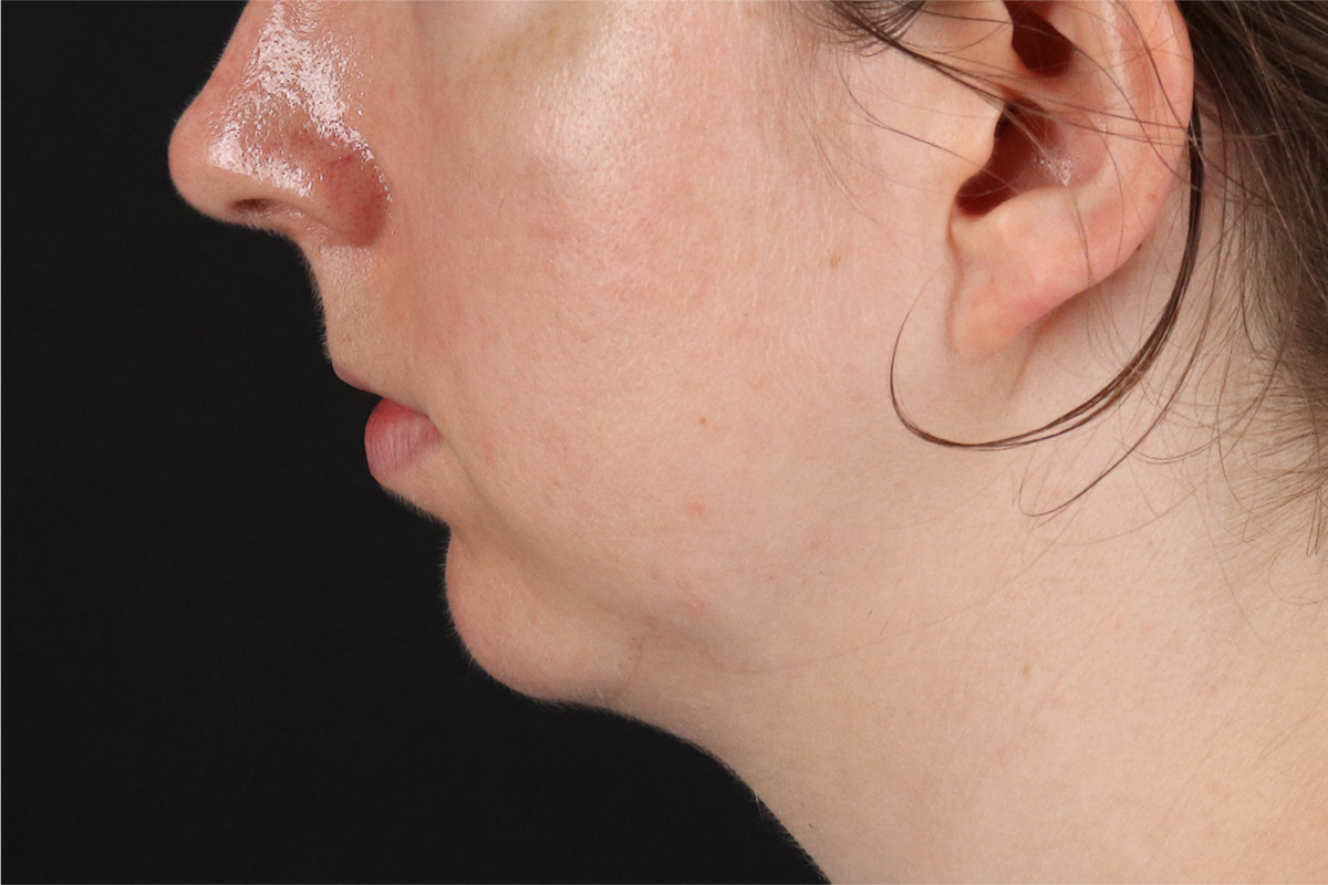 Chin Implant Before & After Patient #13761