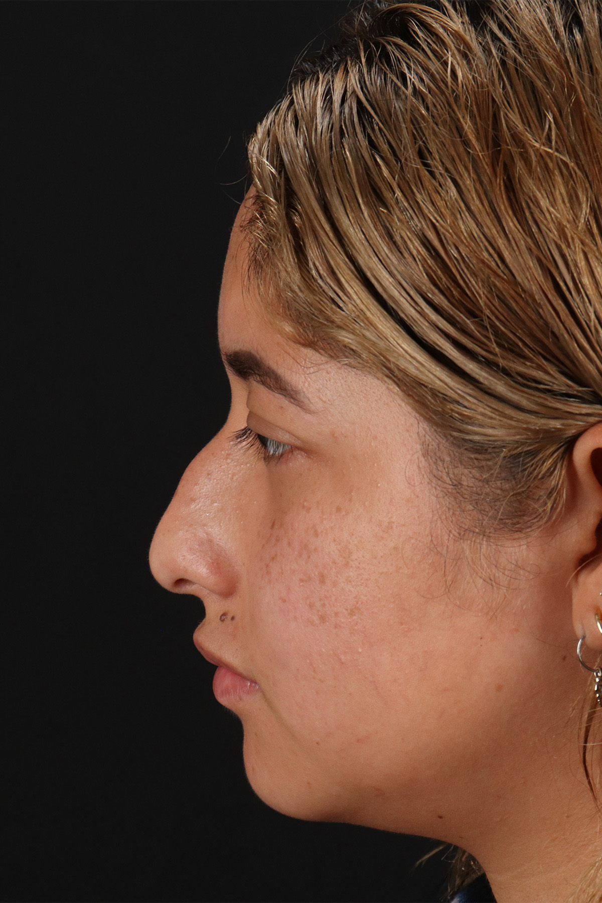 Rhinoplasty Before & After Patient #12491