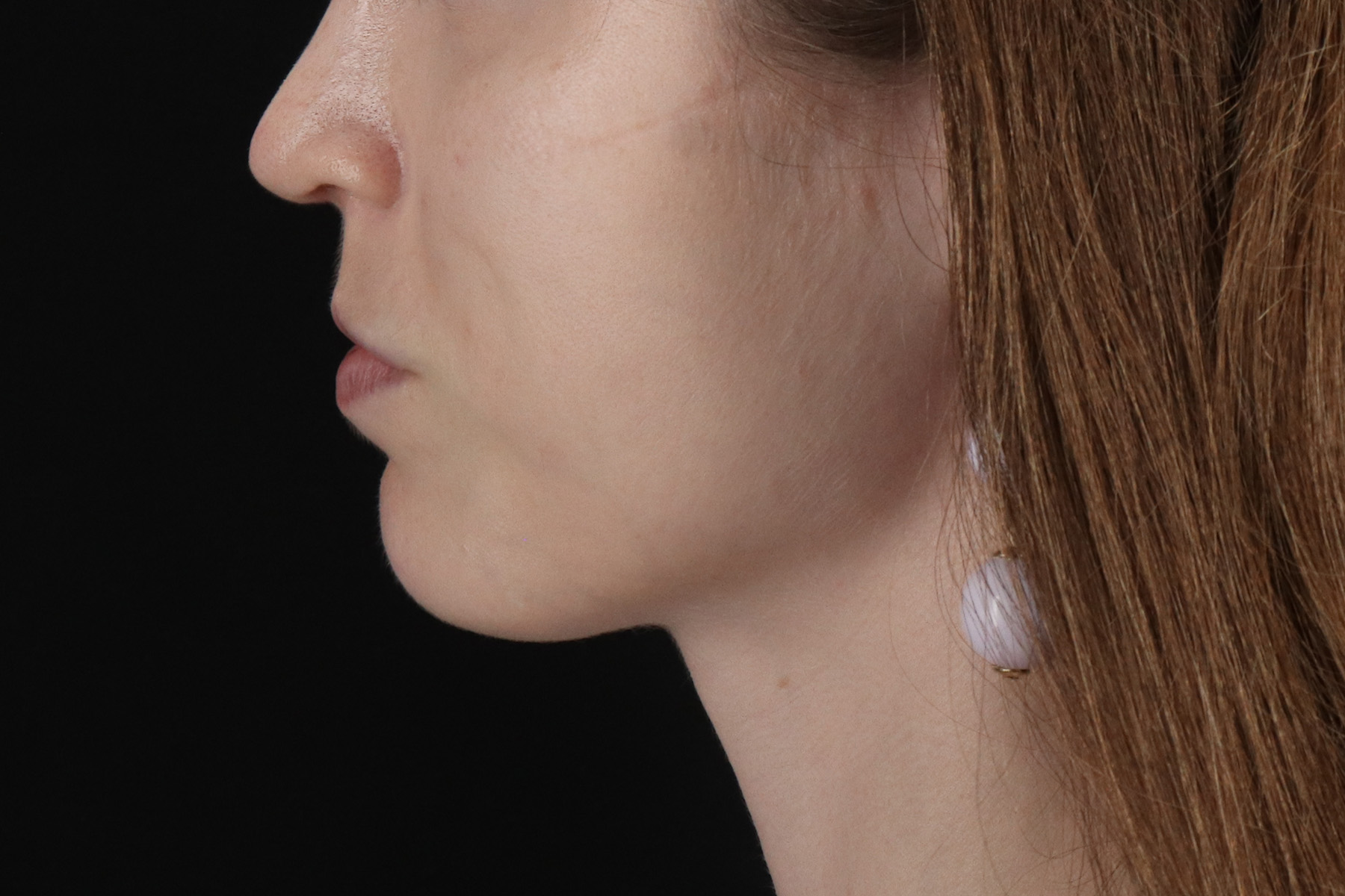 Buccal Fat Pad Before & After Patient #14025