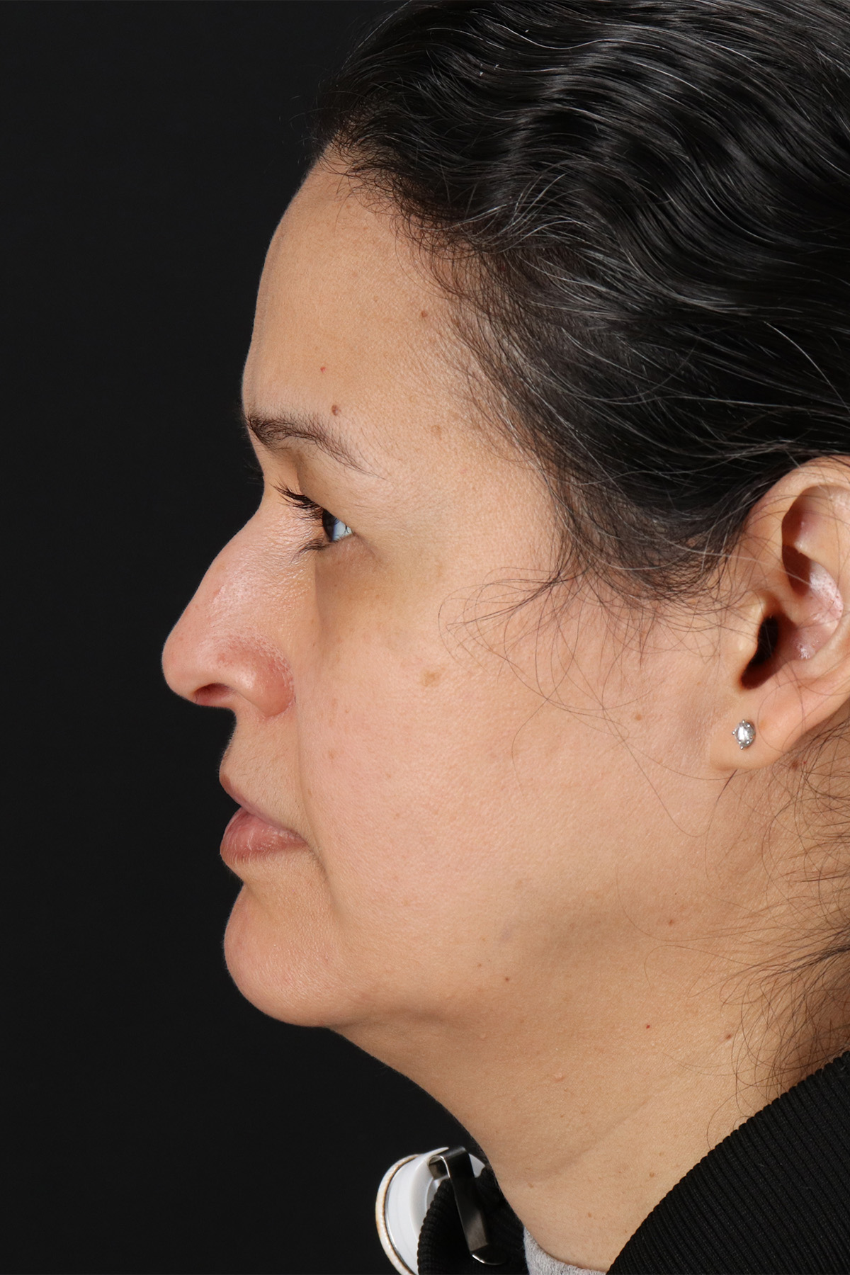 Lower Blepharoplasty Before & After Patient #13019