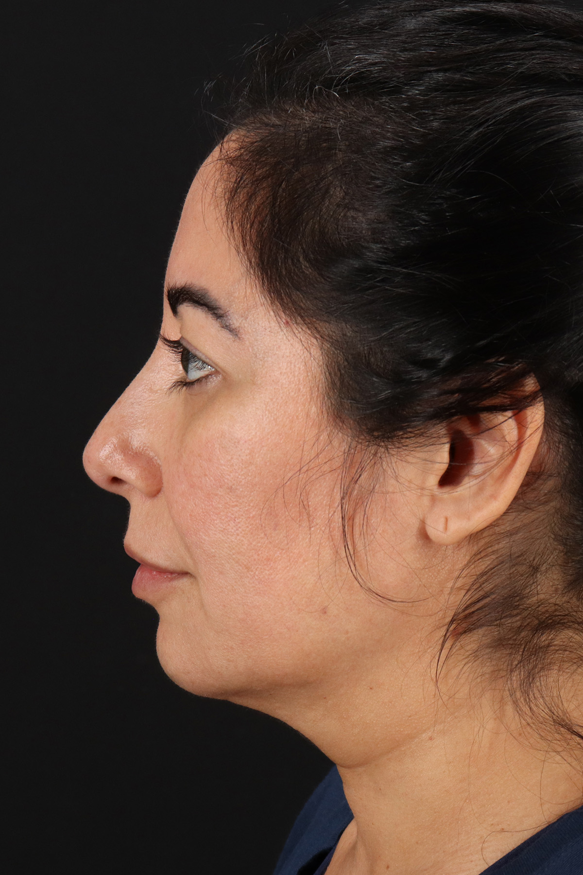 Buccal Fat Pad Before & After Patient #14014