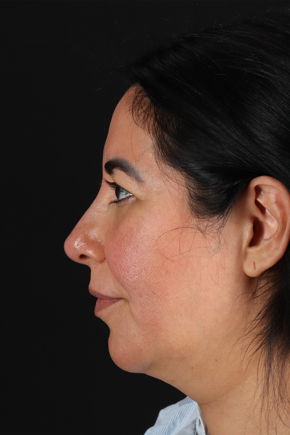 Upper Blepharoplasty Before & After Patient #12062