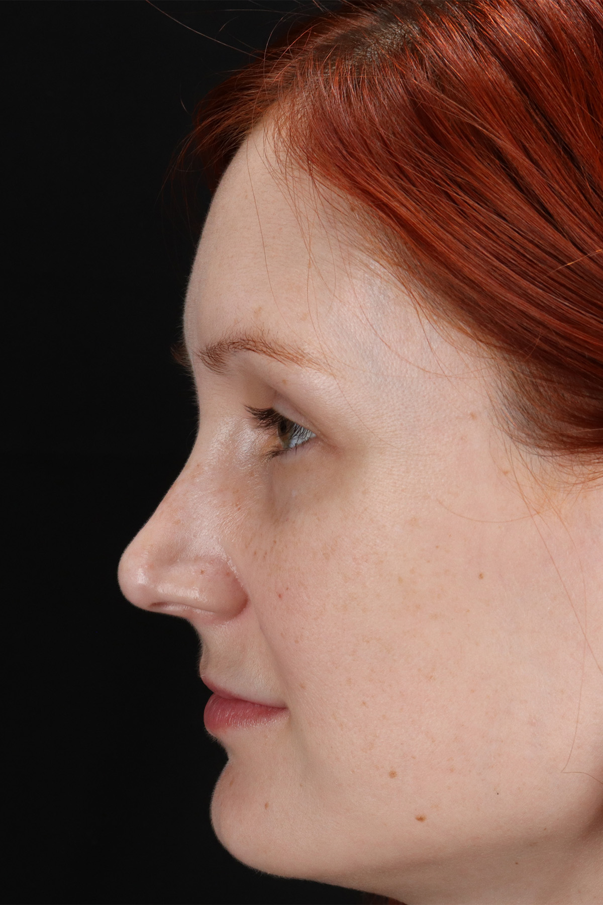 Lower Blepharoplasty Before & After Patient #13008