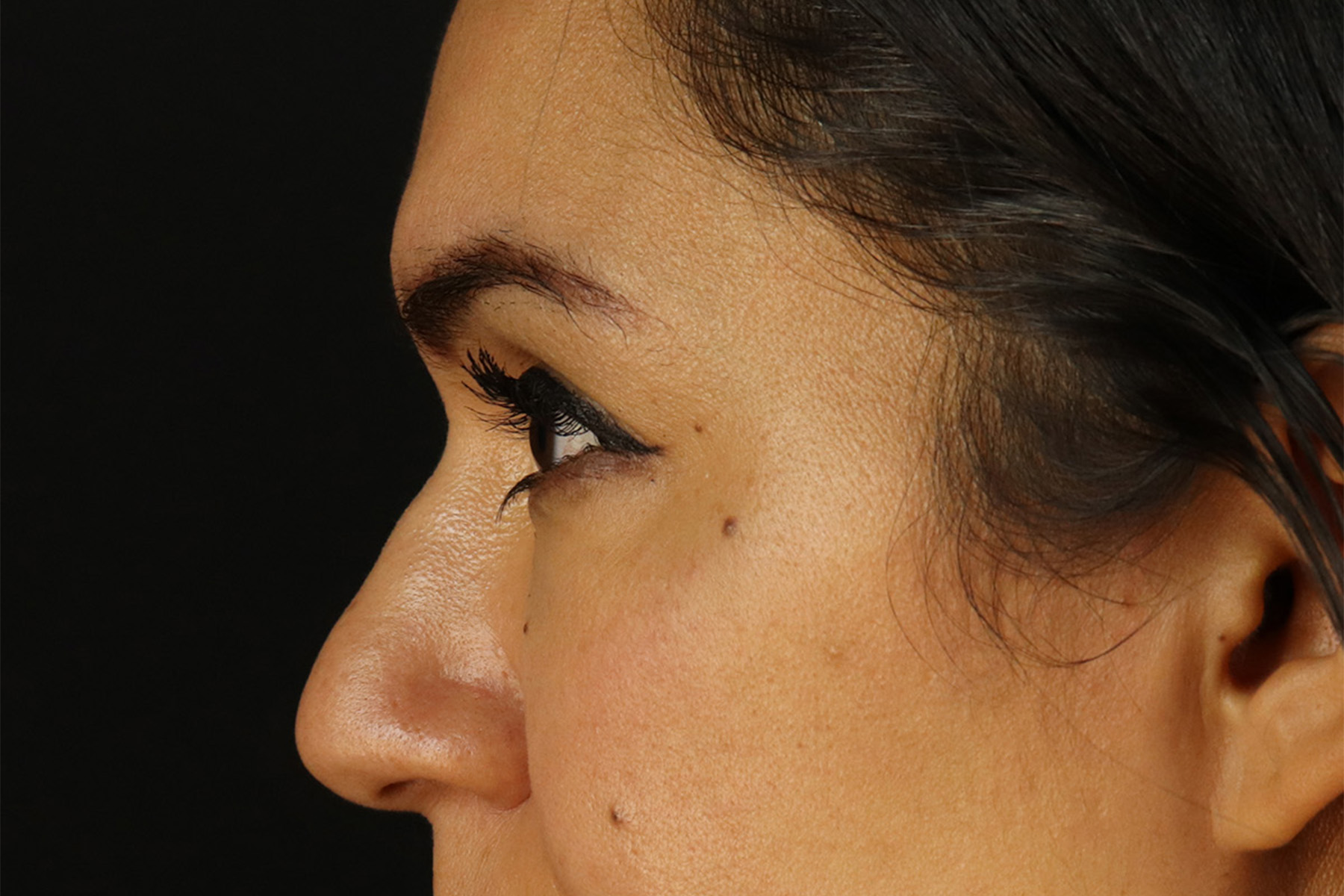 Upper Blepharoplasty Before & After Patient #12007