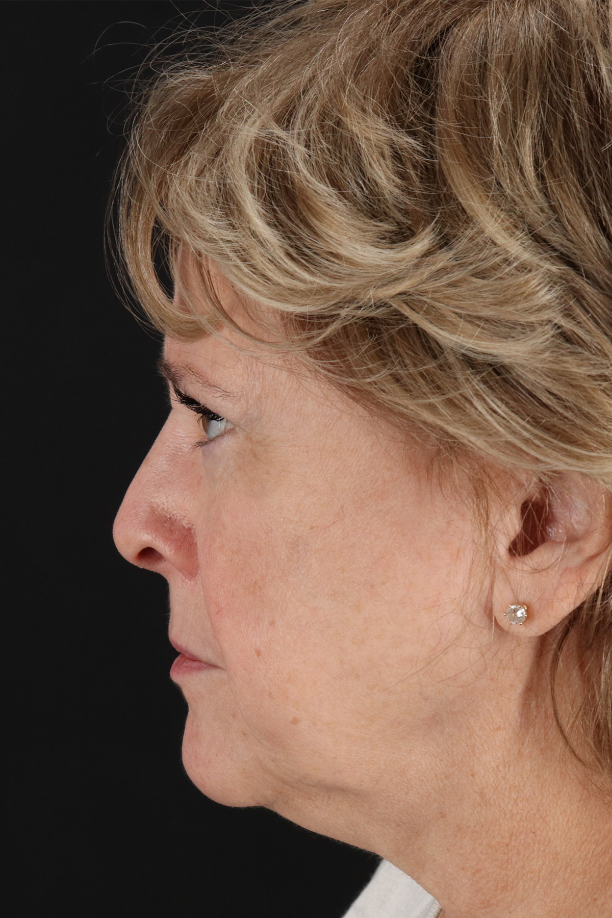 Facelift Before & After Patient #11695