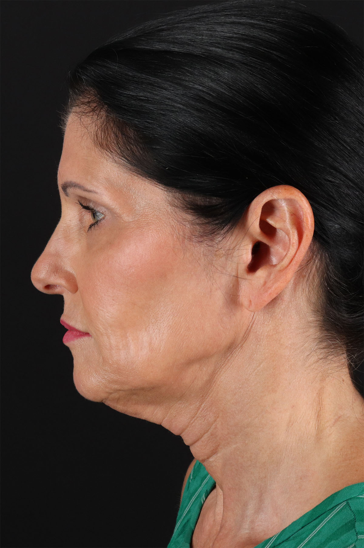 Neck Lift Before & After Patient #12887