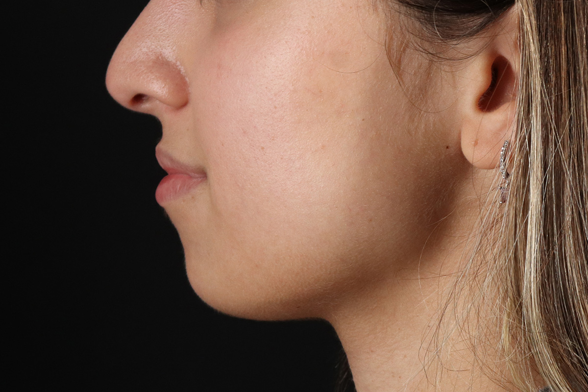 Chin Implant Before & After Patient #13750