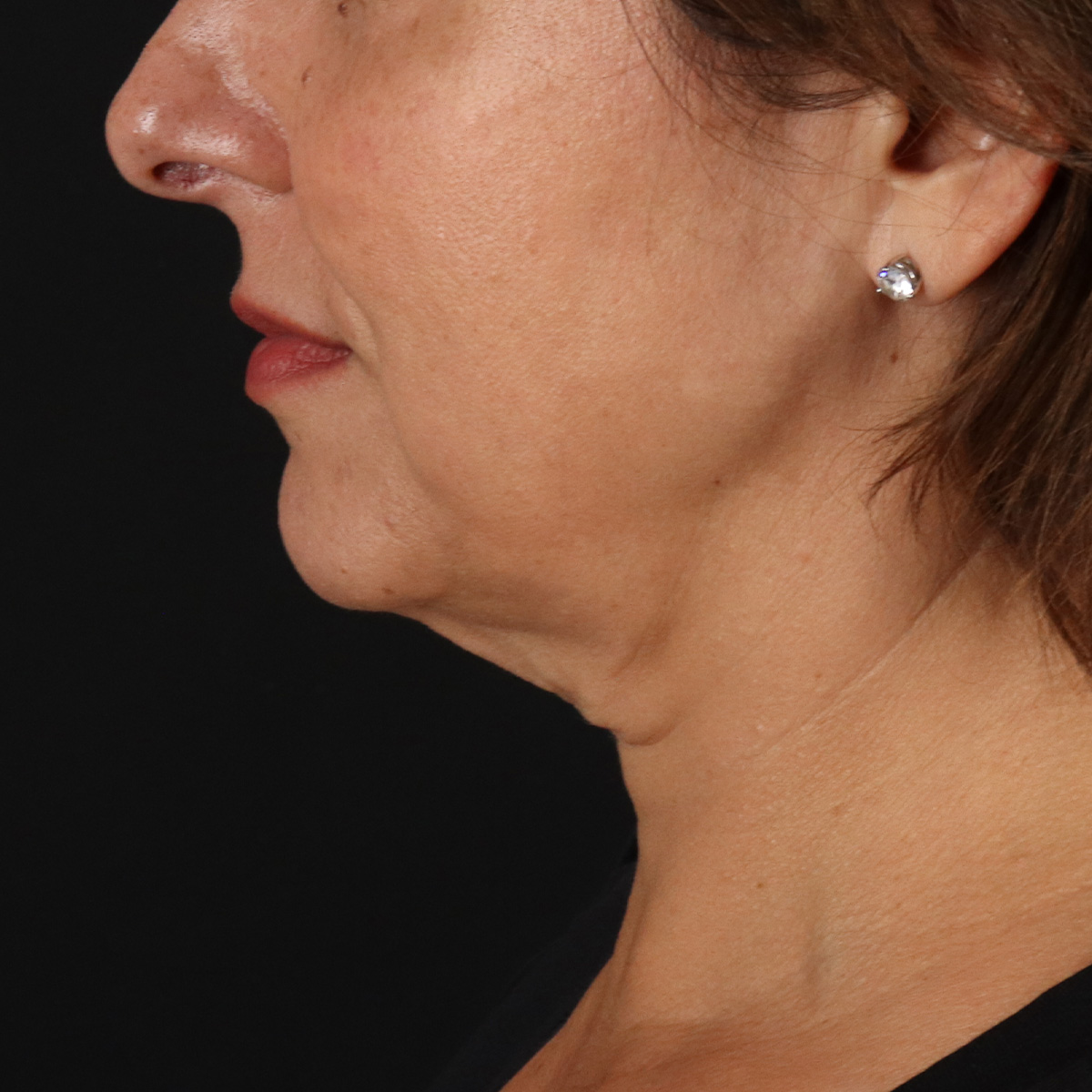 Facelift Before & After Patient #13543