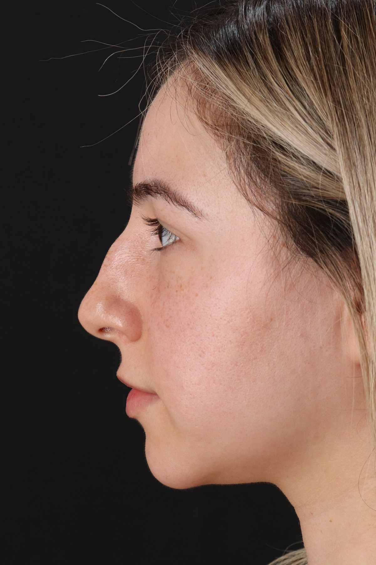 Rhinoplasty Before & After Patient #12271