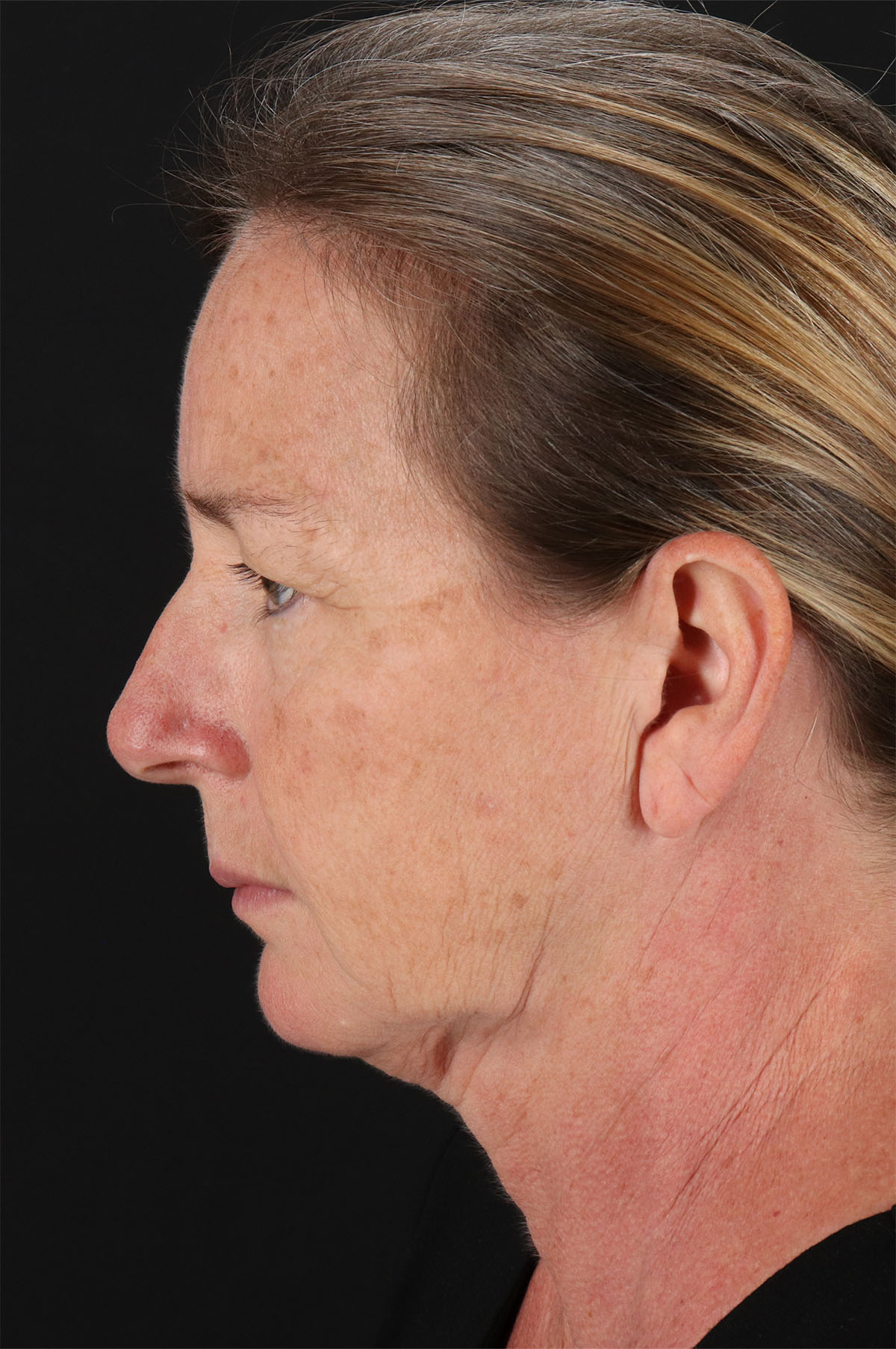 Upper Blepharoplasty Before & After Patient #12040