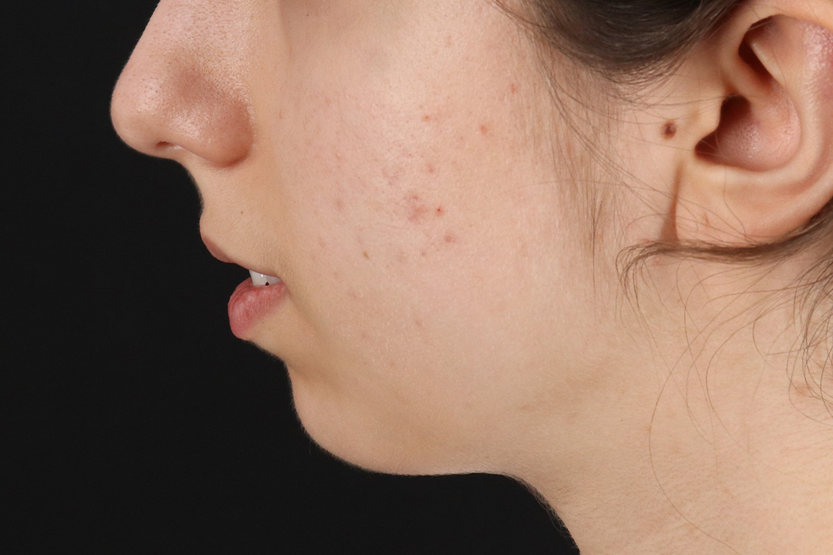Chin Implant Before & After Patient #13772