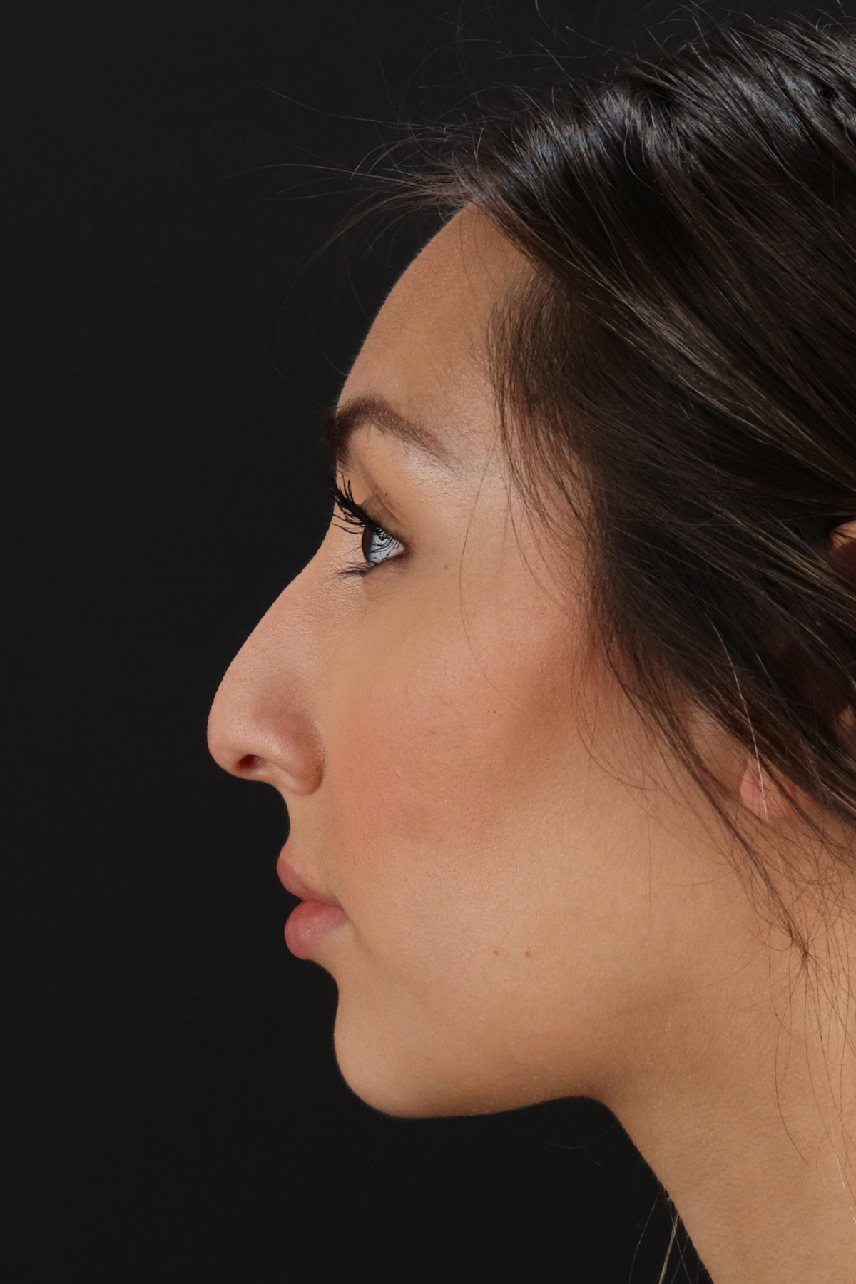 Rhinoplasty Before & After Patient #12480