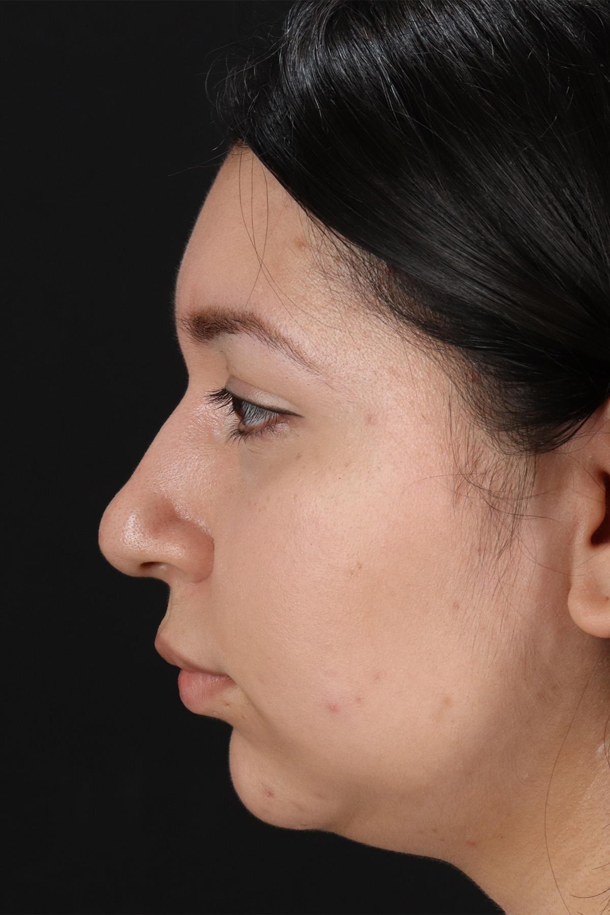 Chin Implant Before & After Patient #13739