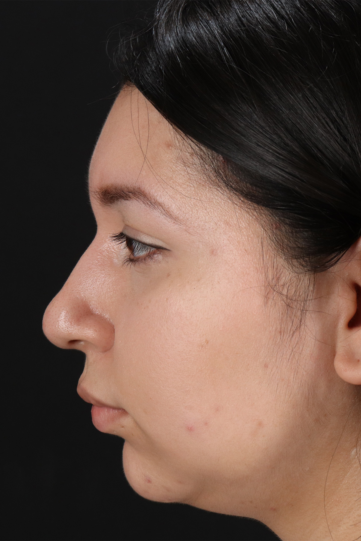 Neck Lift Before & After Patient #11698