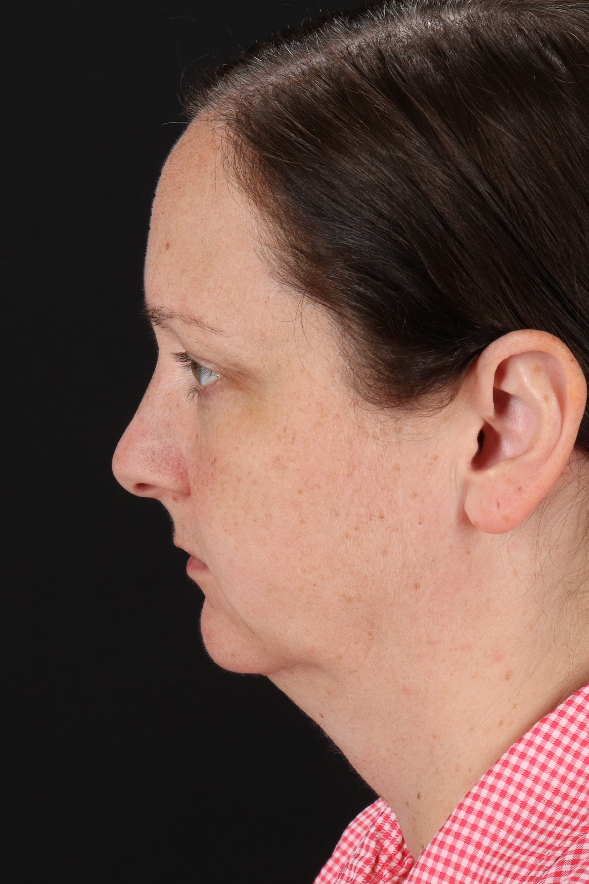 Lower Blepharoplasty Before & After Patient #13052