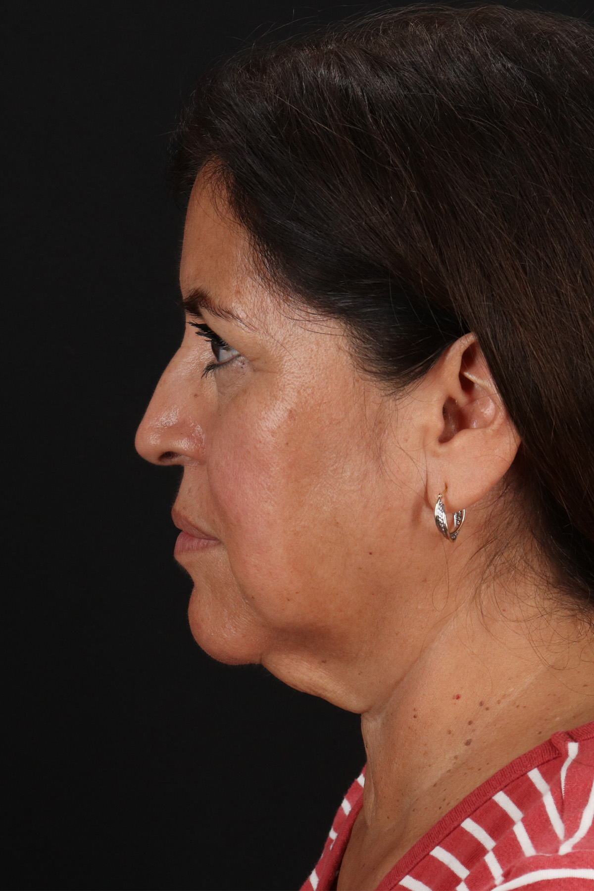 Neck Lift Before & After Patient #12909