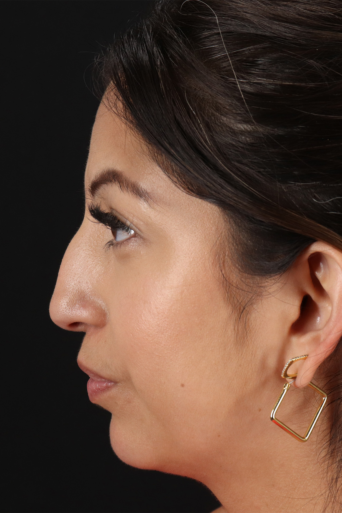 Rhinoplasty Before & After Patient #12458
