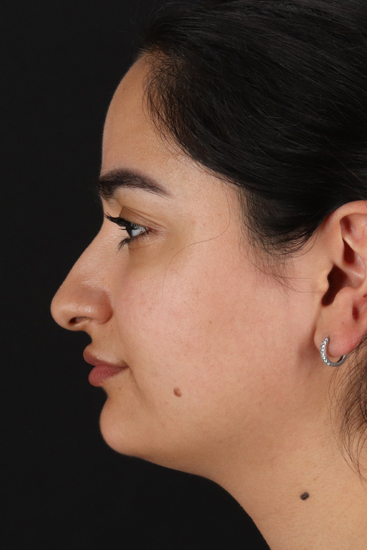 Rhinoplasty Before & After Patient #12436