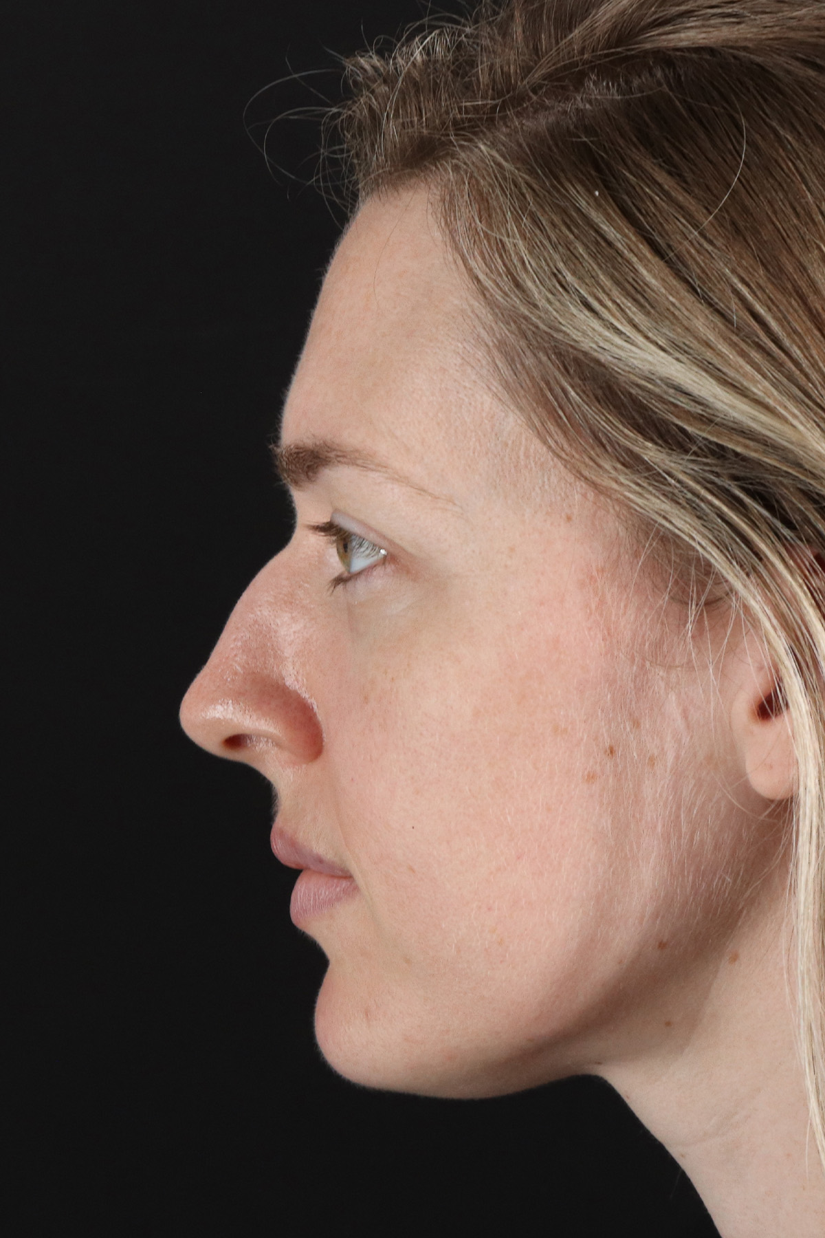 Rhinoplasty Before & After Patient #12227