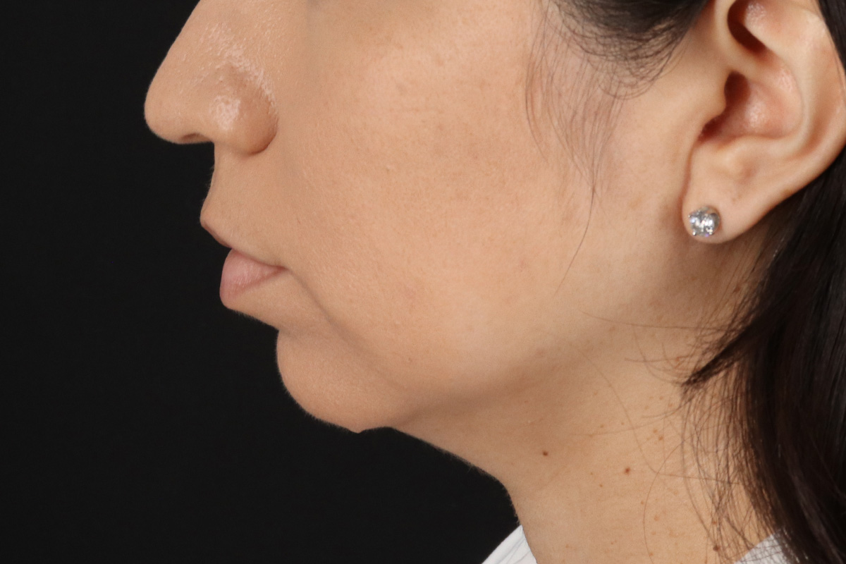 Chin Implant Before & After Patient #13783