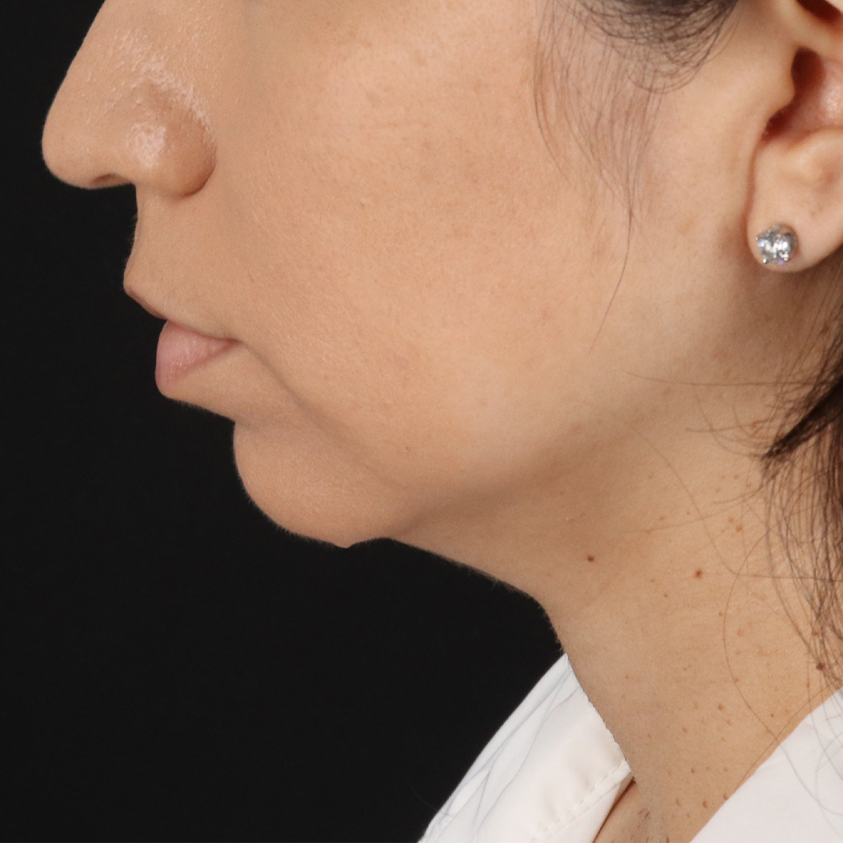 Neck Lift Before & After Patient #14047