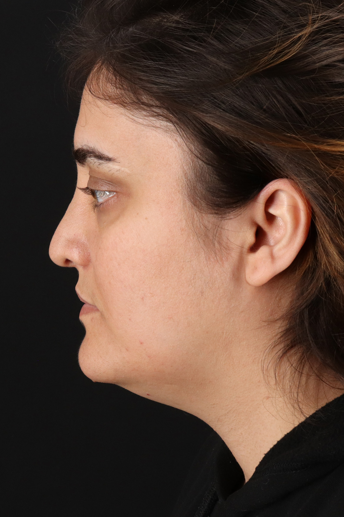Neck Lift Before & After Patient #11565