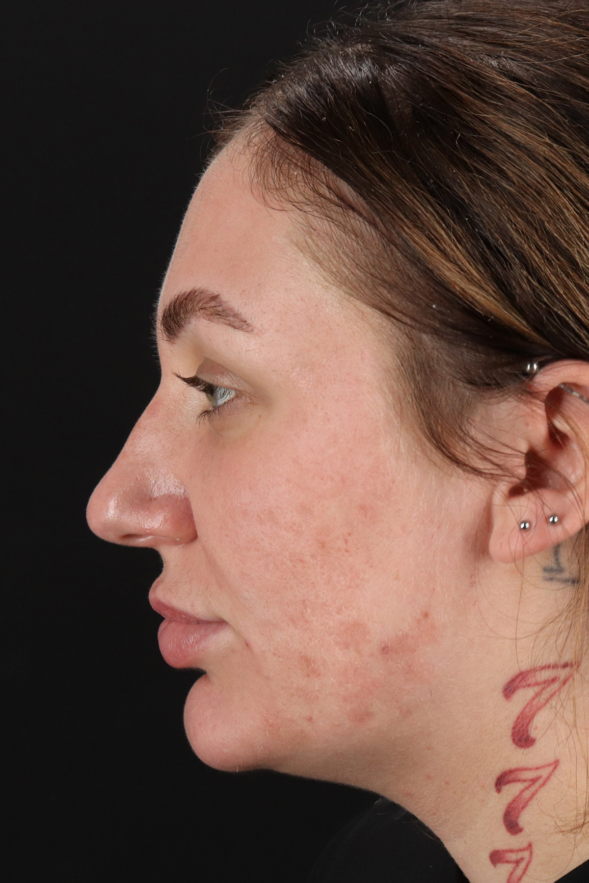 Rhinoplasty Before & After Patient #12403