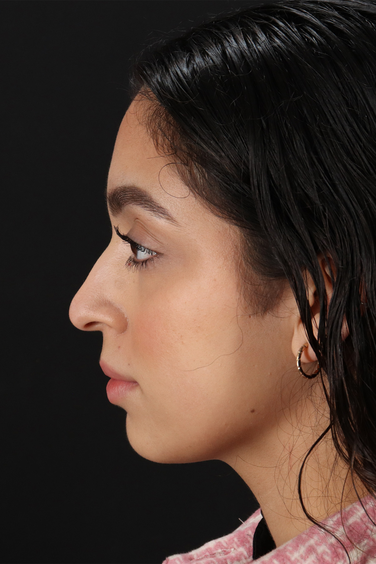 Rhinoplasty Before & After Patient #12249