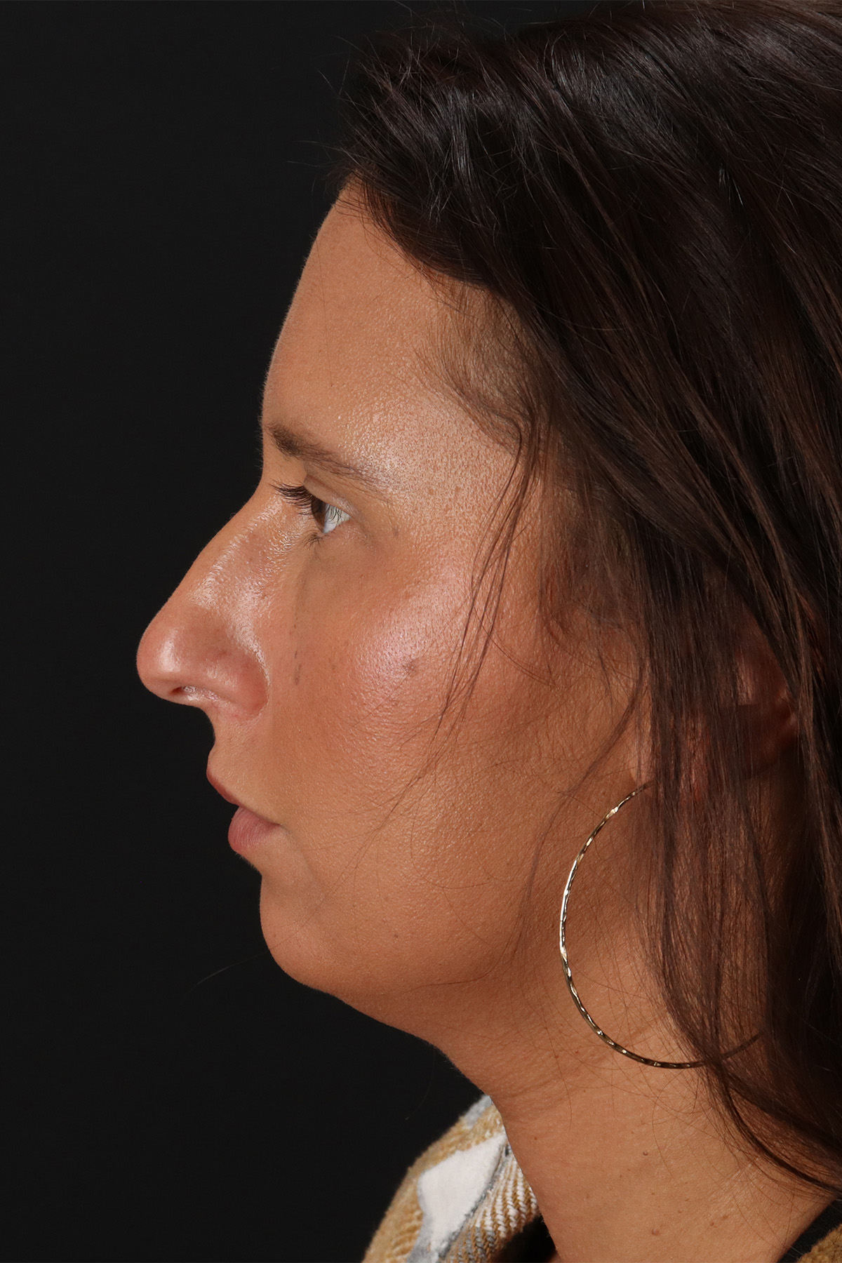 Chin Implant Before & After Patient #13728