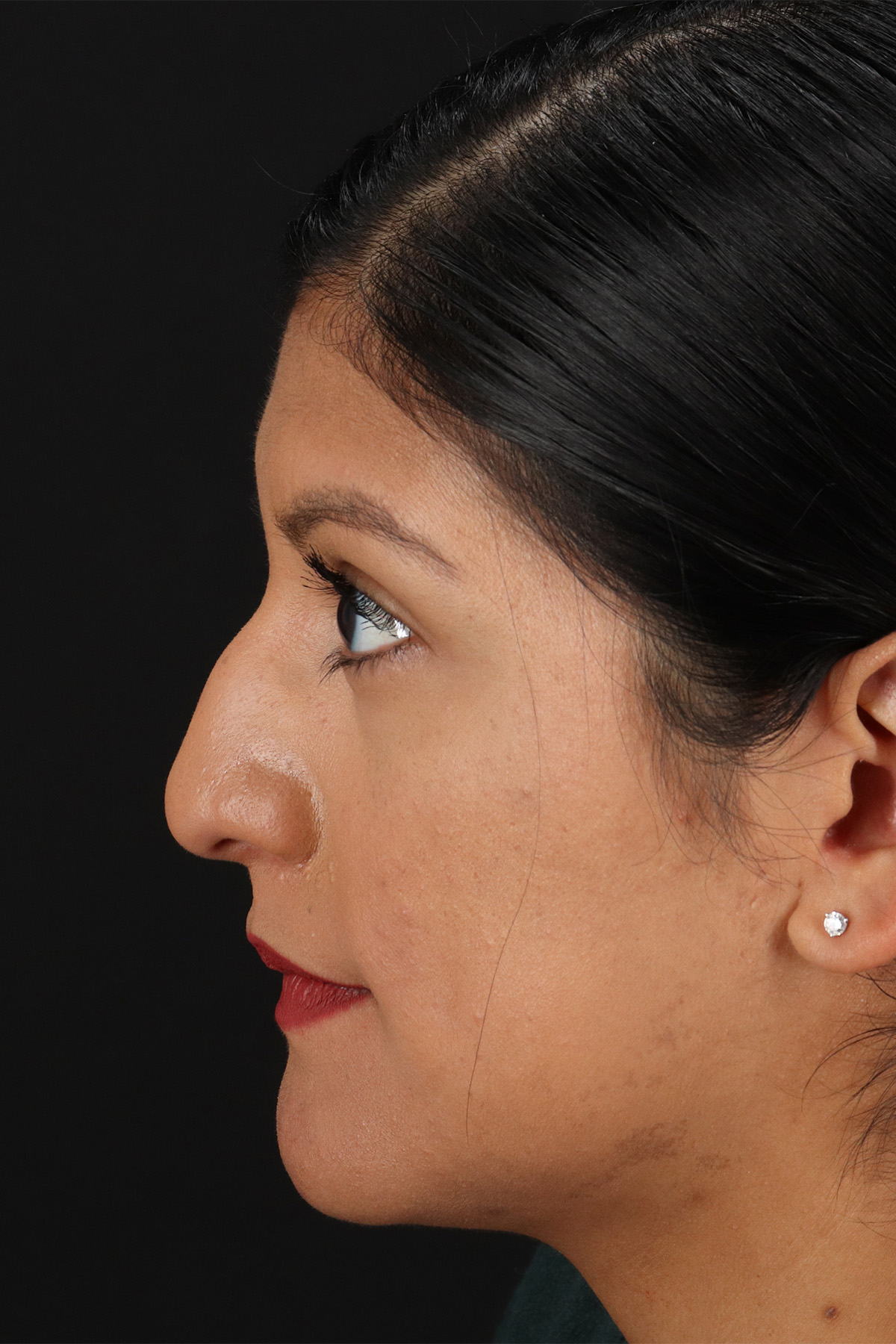 Rhinoplasty Before & After Patient #12337