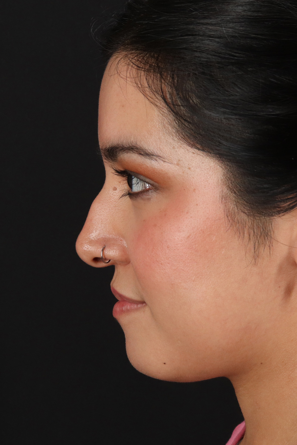 Fillers Before & After Patient #13298