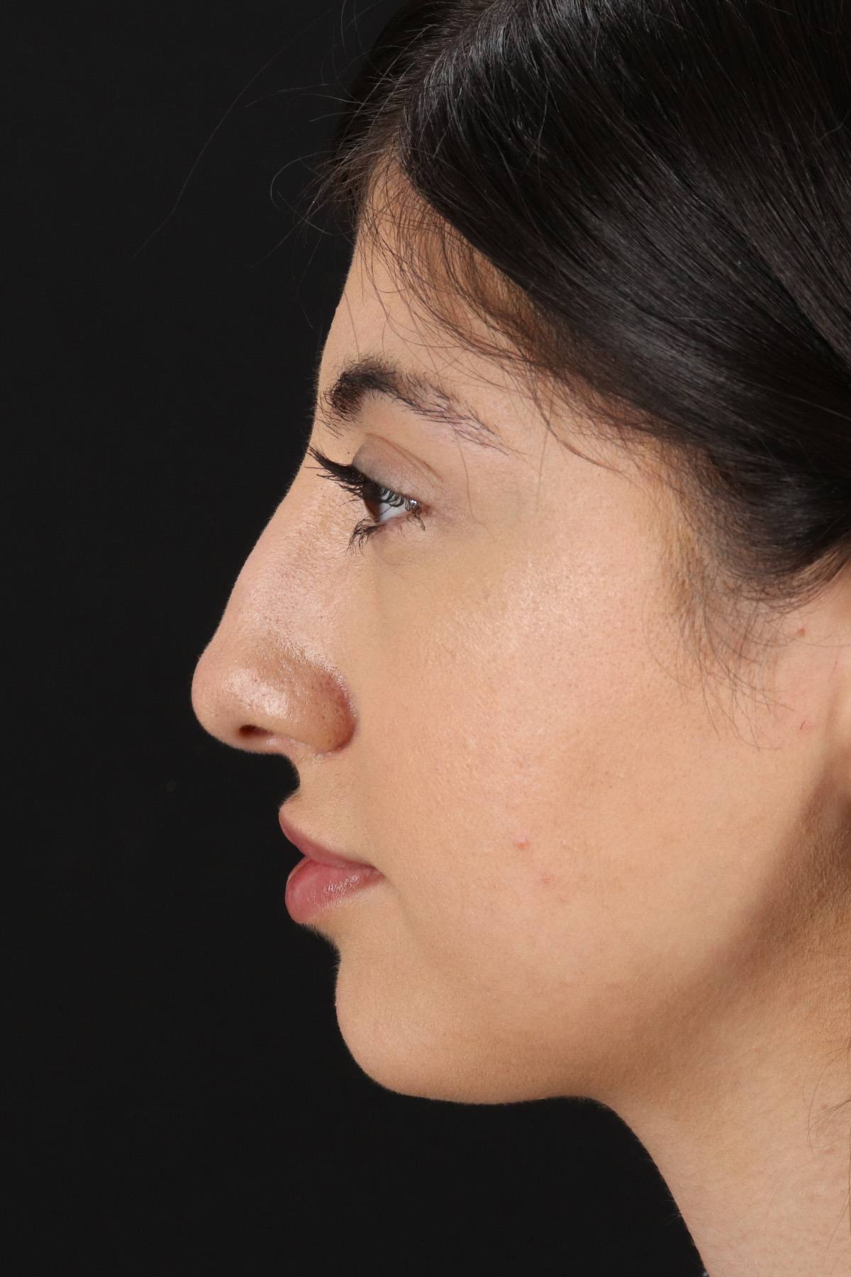 Rhinoplasty Before & After Patient #12304