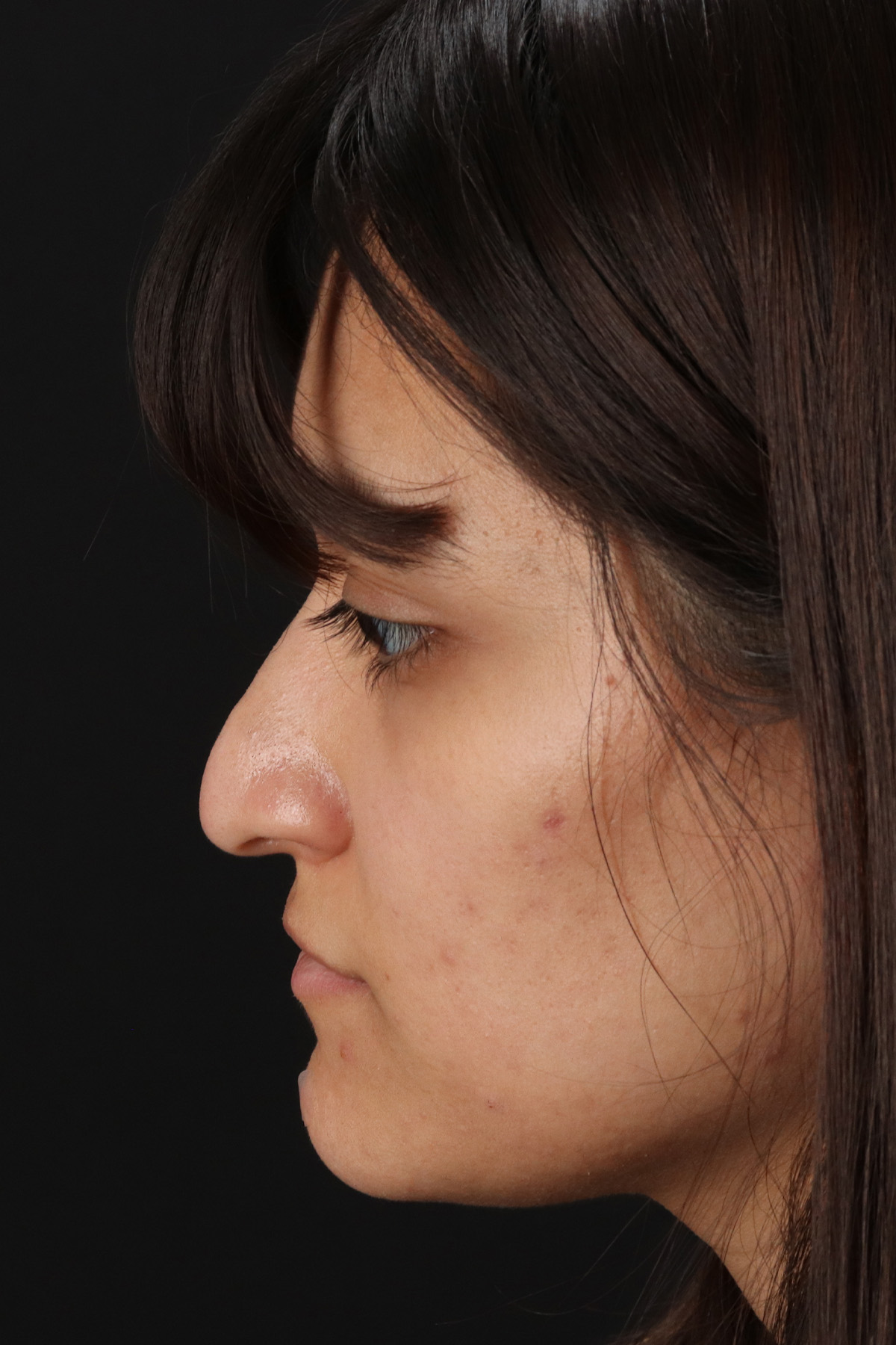 Rhinoplasty Before & After Patient #12469