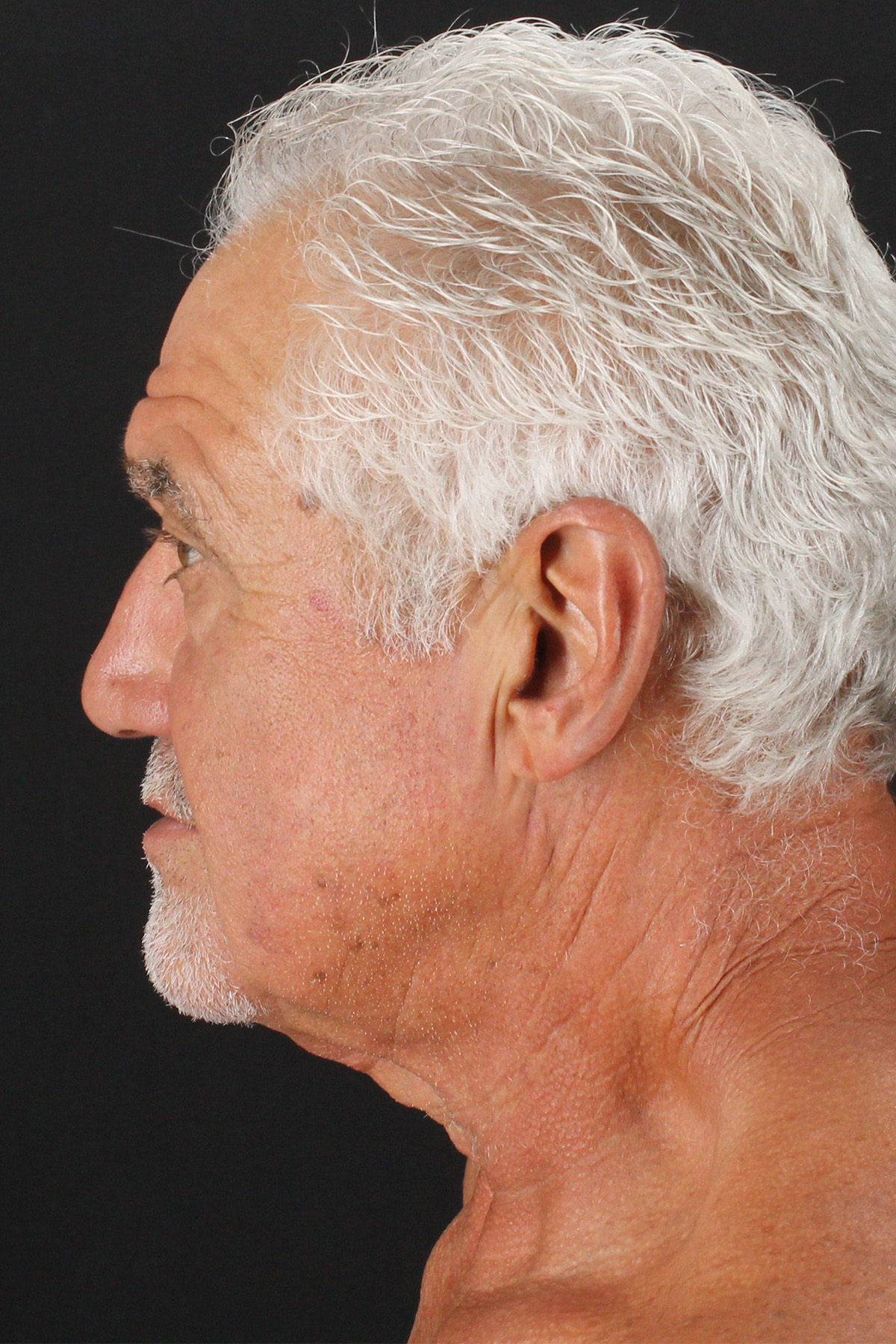 Lower Blepharoplasty Before & After Patient #13096