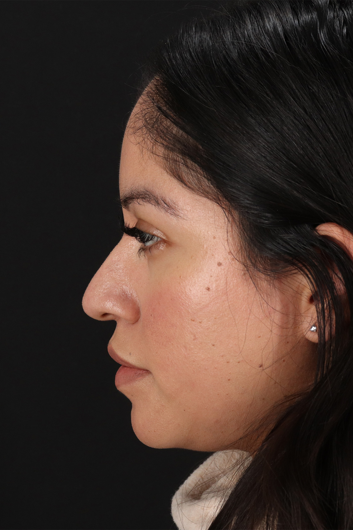 Fillers Before & After Patient #13276